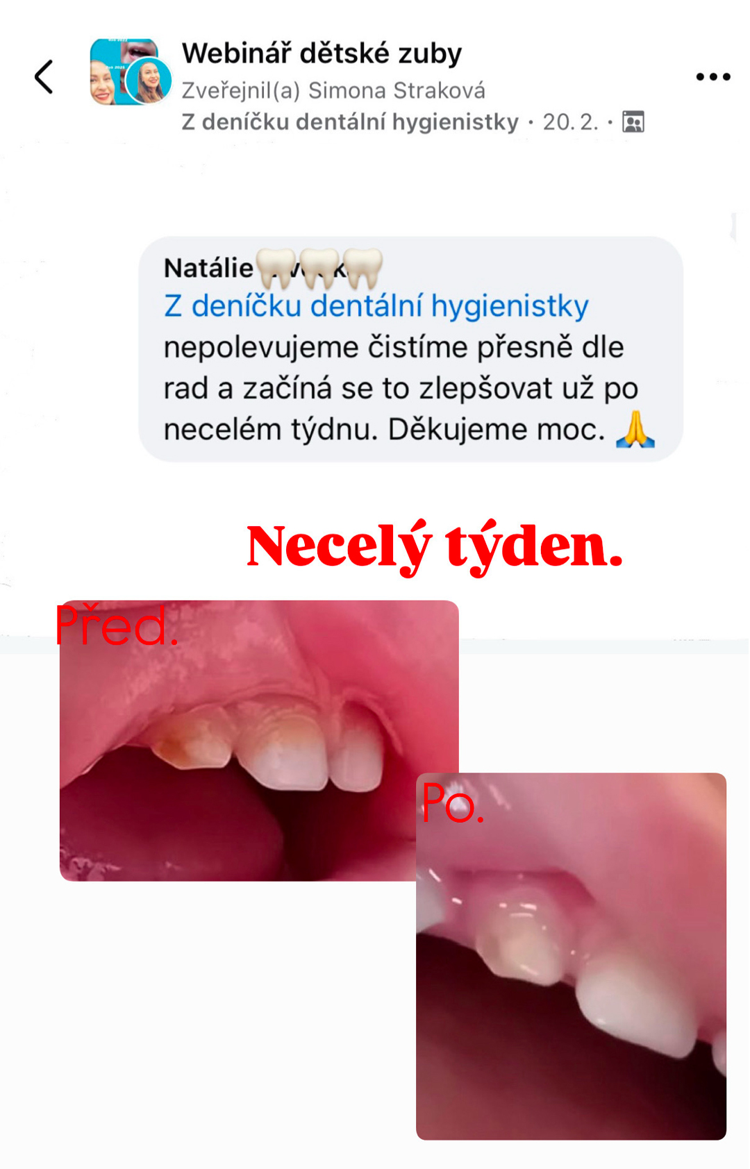 Zuby dítěte před a po necelém týdnu péče podle doporučení